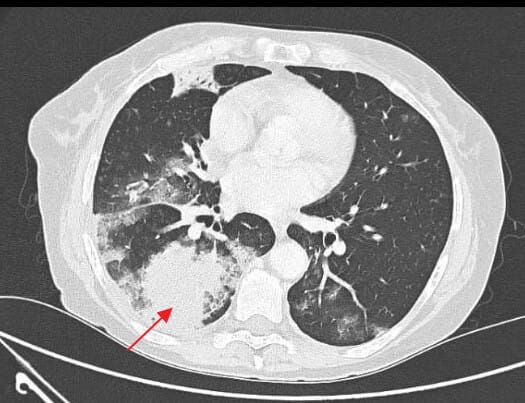 Pneumococcal pneumonia