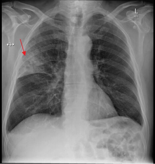 Pneumococcal pneumonia