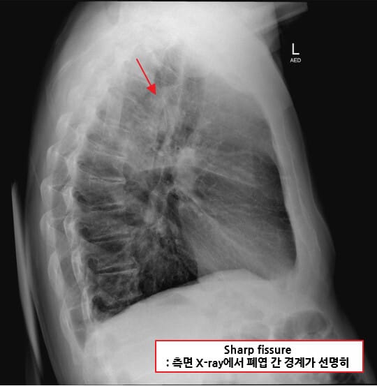 Pneumococcal pneumonia