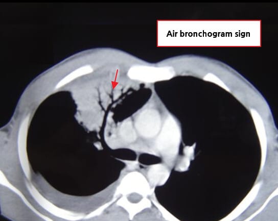 Pneumococcal pneumonia