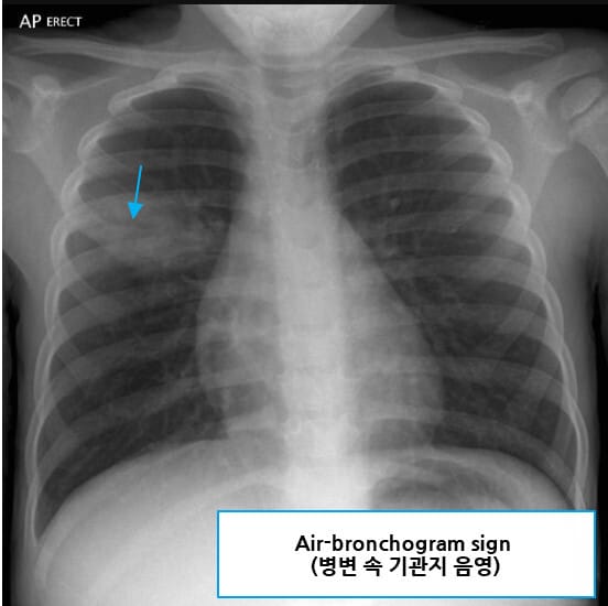 Pneumococcal pneumonia