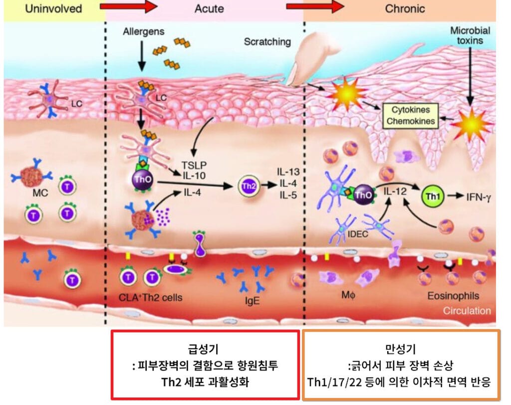 Atopic dermatitis