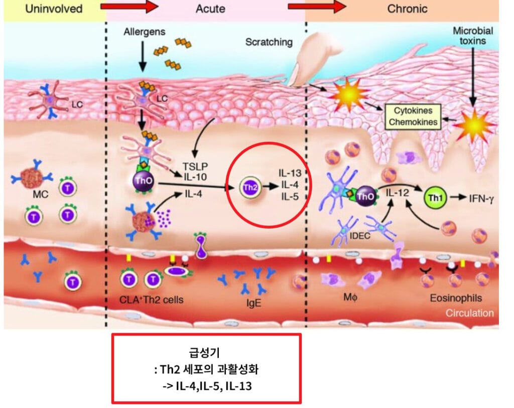 Atopic dermatitis
