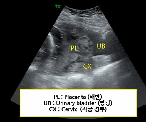 전치태반 (Placenta Previa)