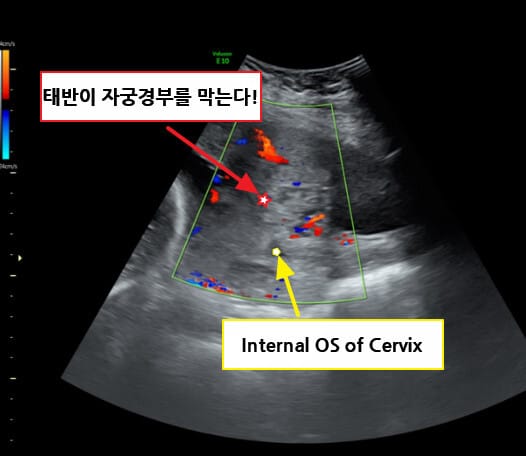 전치태반 (Placenta Previa)