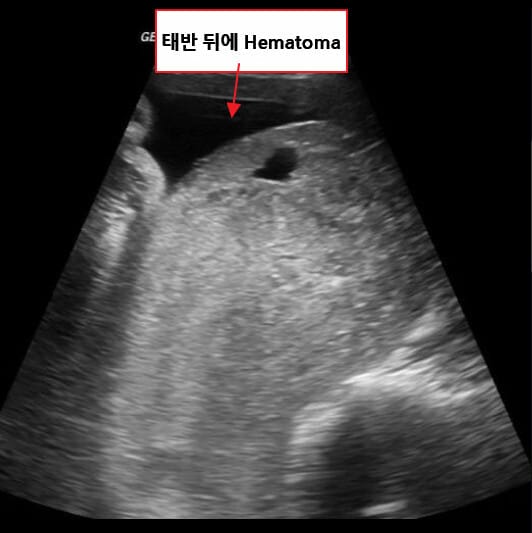 Placental Abruption