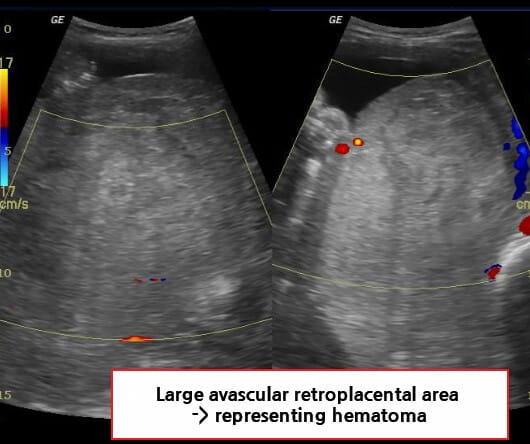 Placental Abruption