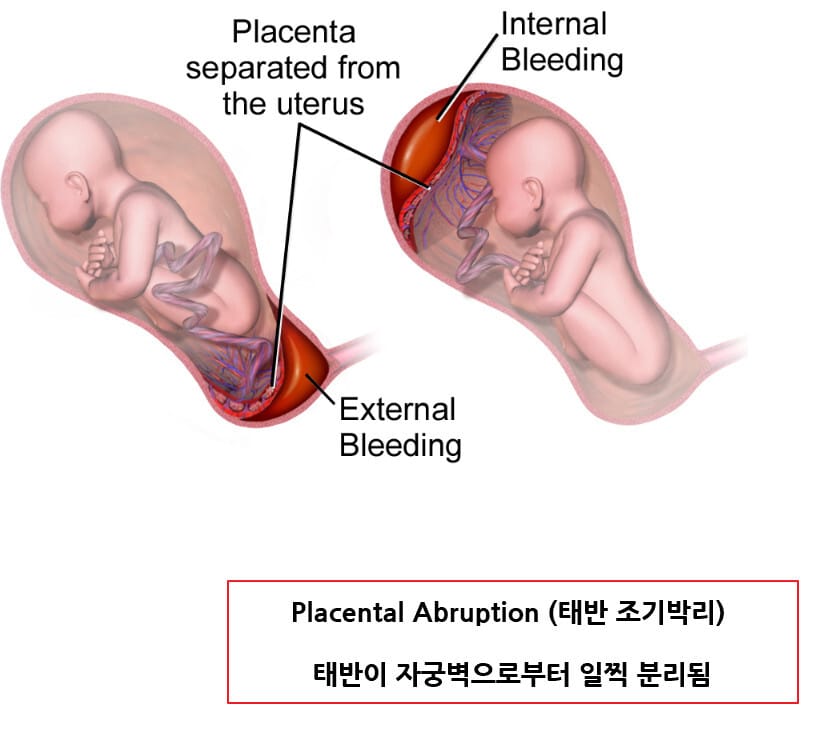 Placental Abruption