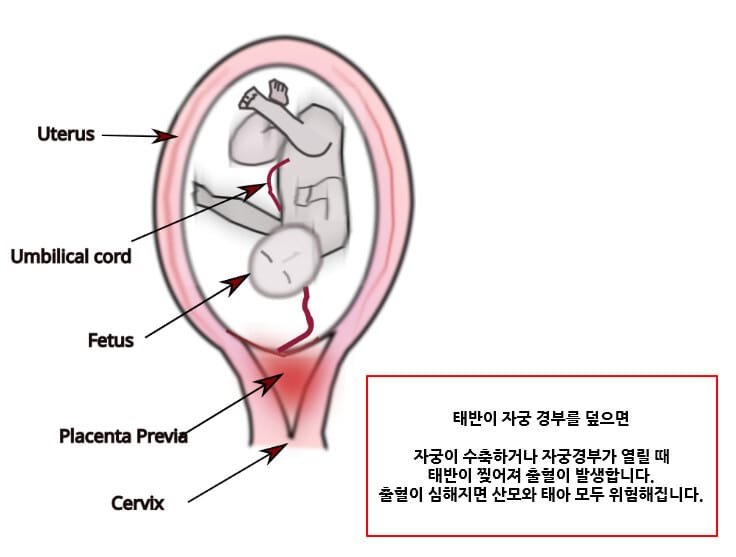 전치태반 (Placenta Previa)