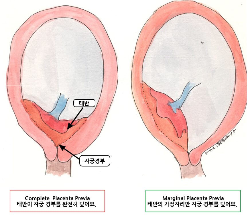 전치태반 (Placenta Previa)
