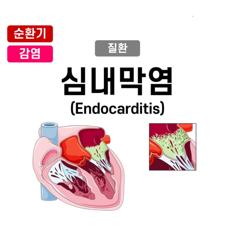 감염 심내막염 (Infective Endocarditis)