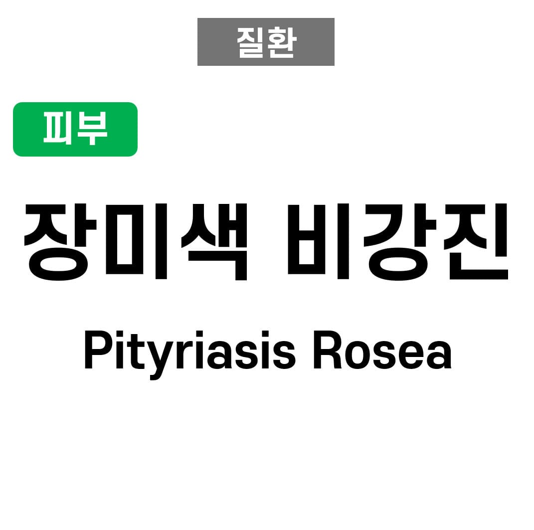 장미색 비강진 (Pityriasis Rosea)