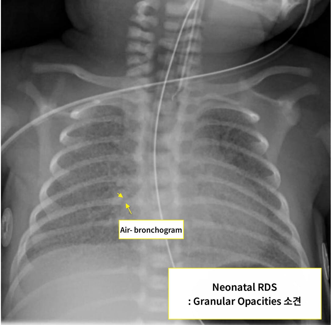 Infant Rds 신생아 호흡곤란 증후군 (Neonatal Respiratory Distress Syndrome) - 의학당