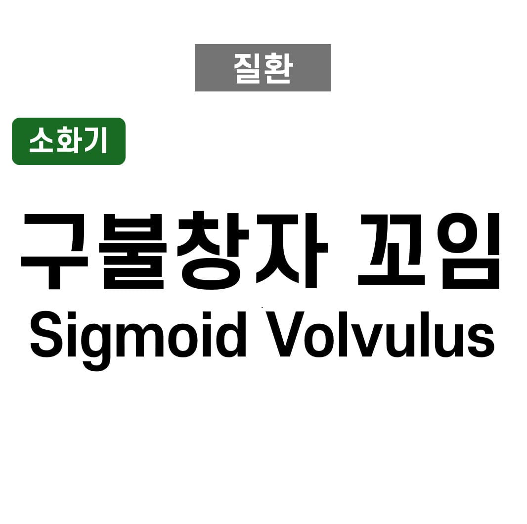 구불창자꼬임 (Sigmoid Volvulus)