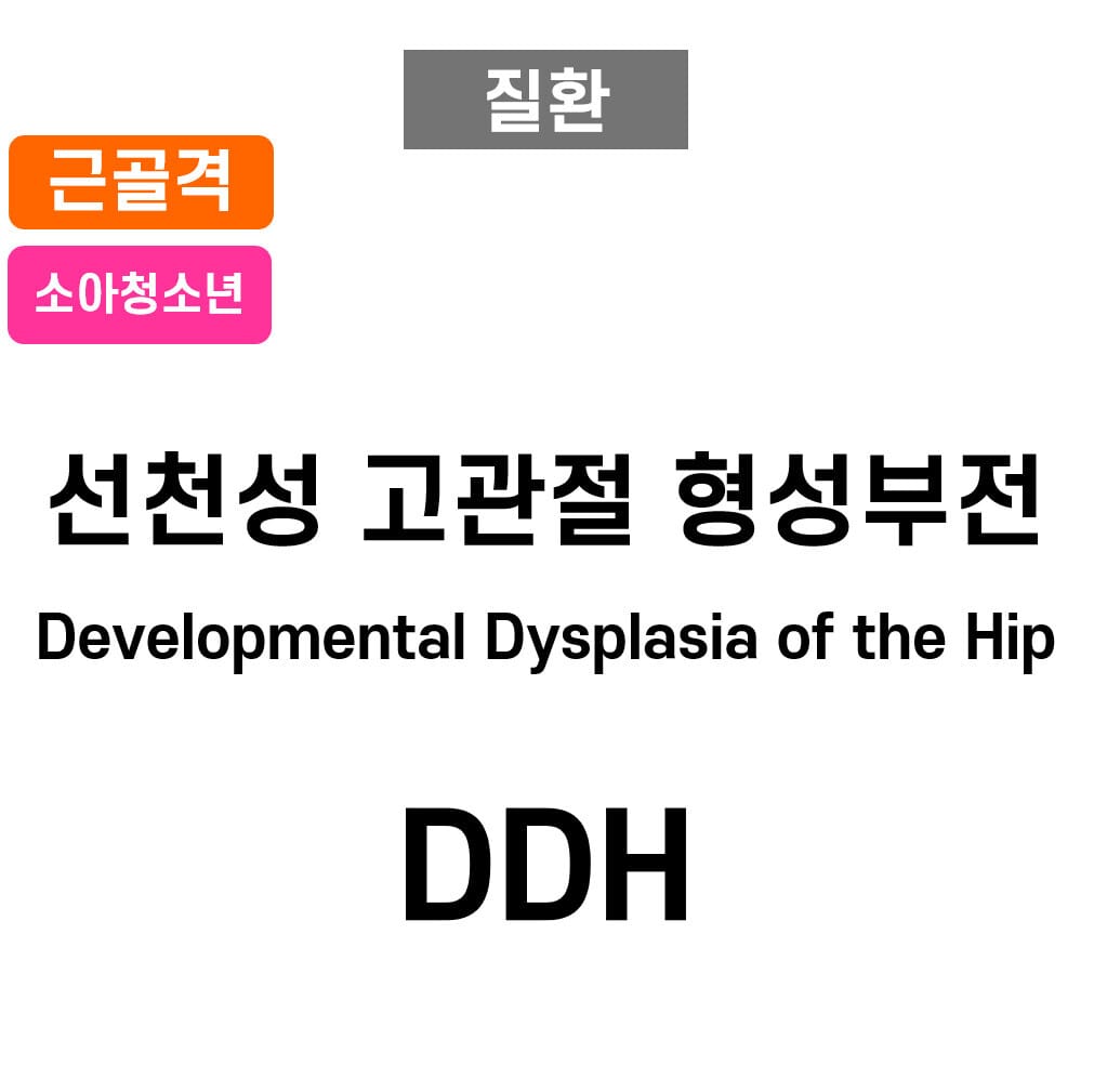 선천성 고관절 형성부전(Developmental Dysplasia of the Hip, DDH)